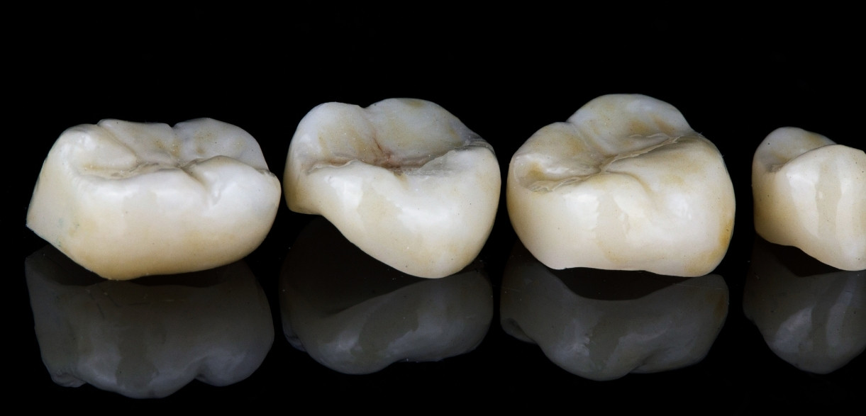 how long do one day cerec crowns last
