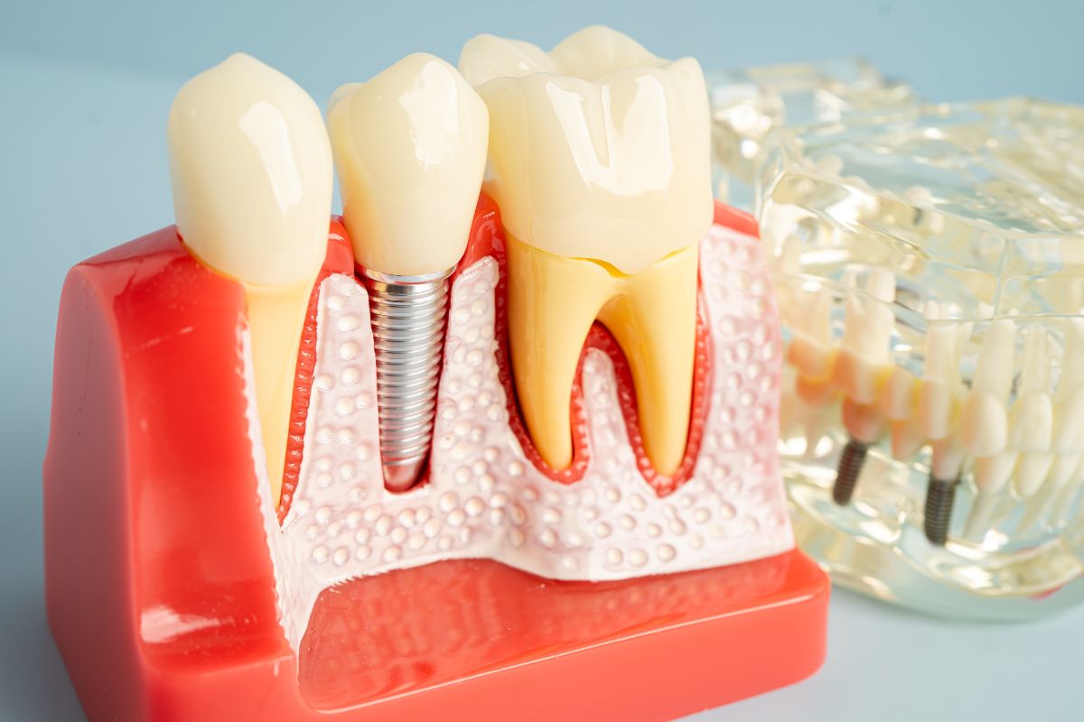 Dental Implant Greeley
