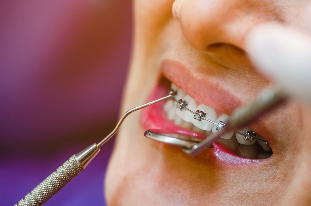Dental Bridges in Greeley